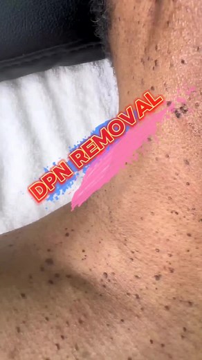 DPN Removal |Dermatology |SkinCare #fyp #dermatology