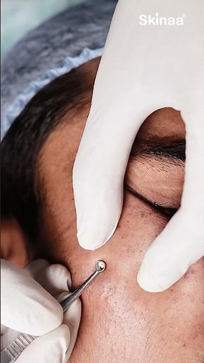 Comedones & Blackheads Removal Explained || #blackheadremoval #comedones #poreskincare #skincare