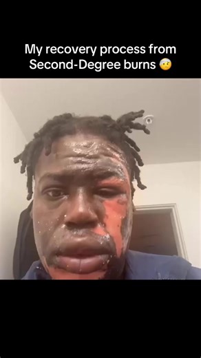 My recovery ❤️‍🩹 to my second-degree burns working on cars #fyp #explorepage✨ #relateable #viral #trusttheprocess