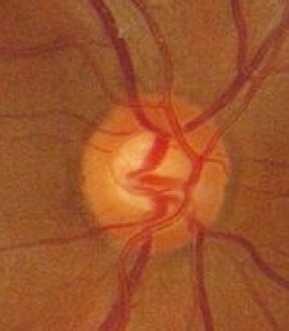 Definition of Ocular Hypertension