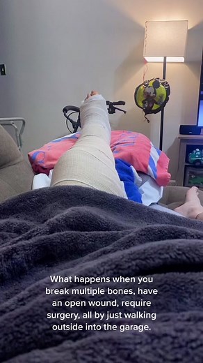 Dealing with a Broken Leg: The Worst Pain of My Life