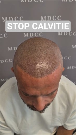 Augmentation de la densité après une greffe de cheveux.