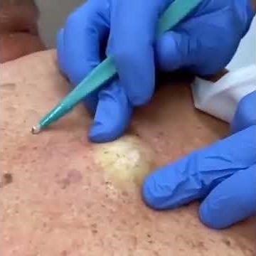 Huge back cyst medical extraction