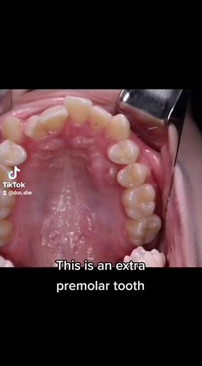 PULING OUT an EXTRA TOOTH | REMOVAL OF SUPERNUMERARY tooth| HYPERDONTIA #SHORTS