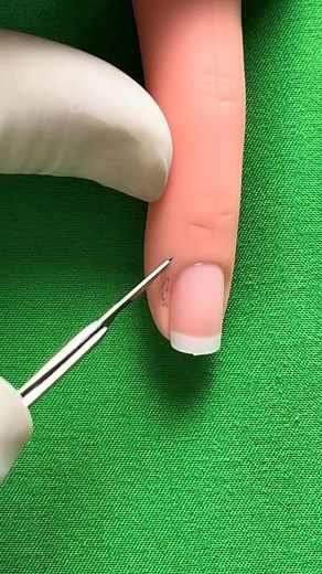 160K views · 625 reactions | Lateral nail fold excision | Dermhacks | Facebook