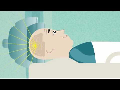 Trattamento con ultrasuoni focalizzati per i tremori dovuti al morbo di Parkinson - Testimonianza: