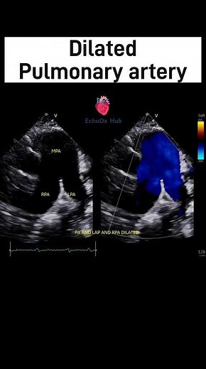 Pulmonary Artery Dilatation on Echo | Causes and Echocardiographic Clues #2decho #echoeducation