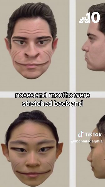 Rare Disorder Causes Distorted