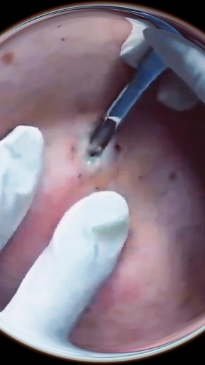 großen Pickel oder Zyste auspressen #akne #mitesser #pickel #aknederm #aknetedavisi #fürdich