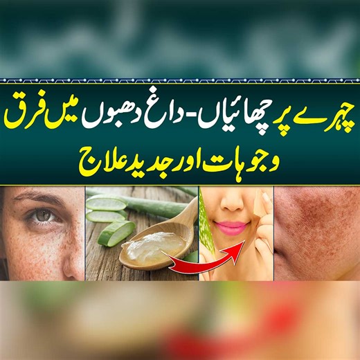 Face Pe Chaiyan Khatam Karne Ka Tarika - Melasma Treatment - Pigmentation Treatment on Face - Face Care #MelasmaTreatment #PigmentationRemoval #SkinCareTips #MelasmaCauses #DarkSpotsTreatment #Hyperpigmentation #Dermatology #SkinWhitening #FaceCare #BeautyRemedies | Sehat Mand - Health & Lifestyle