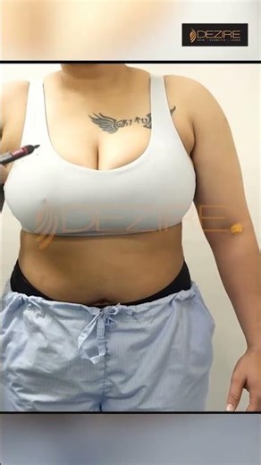 Double Incision FTM Top Surgery Planning | #ftm #topsurgery #awareness