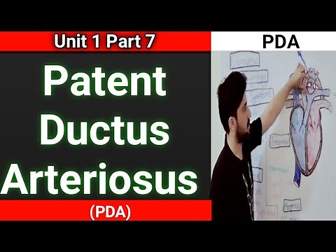 patent ductus arteriosus | pda congenital heart disease