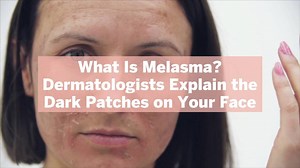 What Is Melasma? Dermatologists Explain the Dark Patches on Your Face—And How to Treat Them