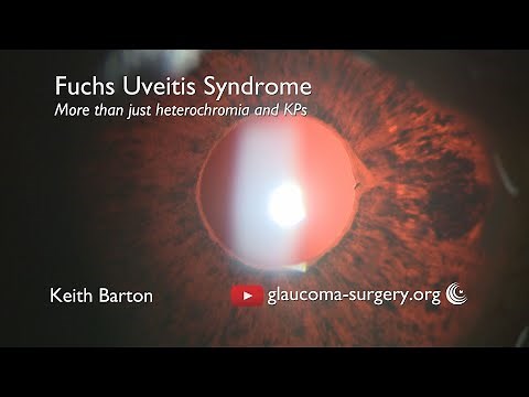 Fuchs Uveitis Syndrome - The Clinical Features - More than Heterochromia and KPs