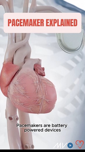154K views · 1.2K reactions | ⚡️ Pacemakers 101 A pacemaker is a...