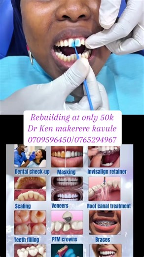 Cuidado y Limpieza de Retenedores Dentales