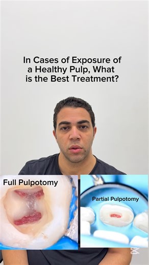 Mohamed Fakhr on Instagram: "If you have a healthy or reversibly inflamed exposed pulp, What would be the best line of treatment to Save that Pulp?"