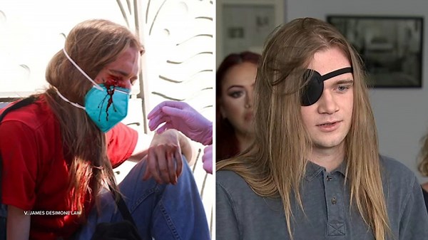 USC student prepares to file lawsuit against DHS after losing eye during 'No Kings' rally in LA