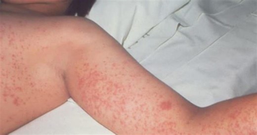 Minnesota Department of Health looks to get a handle on measles outbreak