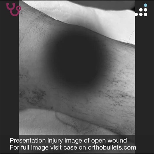 Open Pilon Fracture in 56M Hunter | Orthobullets | 39 comments