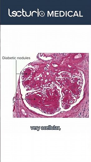 Diabetic Nephropathy: Leading Cause of Kidney Failure in the U.S.