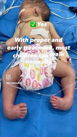 Clubfoot (CTEV) Treatment Options in Short | Ponseti Method,Bracing & Surgery Explained #pediatrics