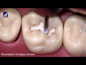 Class I Cavity Preparation , H shape, Tooth # 16