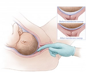 Membrane Sweep at 37, 38, 39, 40 Weeks, Success Rate, Risks, Safety & Cramping — Brighter Press