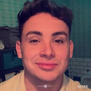 LIP PLUMP | MALE LIP AUGMENTATION