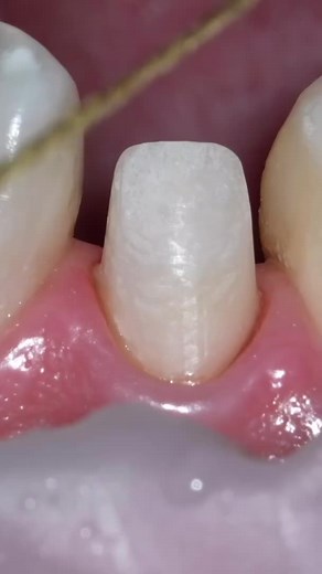 Gingival Retraction Cord Packing Techniques in Dentistry