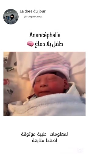 ‎La Dose Du Jour 🧪جرعة اليوم‎ on Instagram‎: "طفل بلا دماغ 🧠Anencéphalie – انعدام الدماغ 🧠❌ 🔍 ما هي؟ هي عيب خلقي خطير في تكوّن الجهاز العصبي المركزي، حيث يولد الطفل بدون أجزاء كبيرة من الدماغ والجمجمة، نتيجة فشل أنبوب الأعصاب (Tube neural) في الإغلاق الكامل خلال الأسابيع الأولى من الحمل. ⚠️ الأسباب المحتملة • نقص حمض الفوليك أثناء الحمل (Carence en acide folique) • عوامل وراثية (Facteurs génétiques) • التعرض لمواد سامة أو أدوية معينة أثناء الحمل (Exposition à des substances toxiques) 📋 الأع