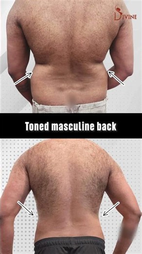 Male Back Liposuction Before and After #shortsfeed