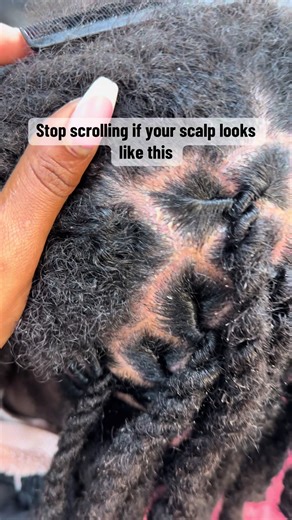 Effective Techniques for Healing Scalp Inflammation