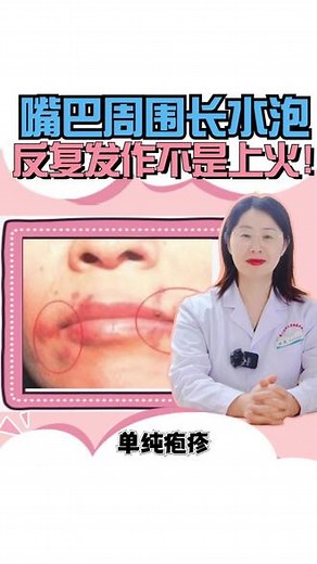 #医学科普 嘴唇长水泡是因为上火？小心是疱疹病毒感染！ #皮肤 #健康