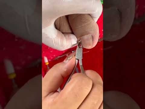 ingrown toenail and dryskin removal #edwardcabbat