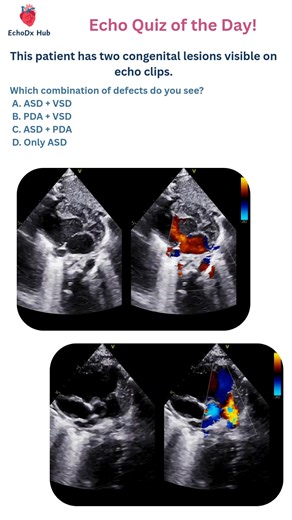 EchoDx Hub 🫀 on Instagram: "🩺 Echo Quiz of the Day! This patient has two congenital lesions visible on echo clips. Which combination of defects do you see? A. ASD + VSD B. PDA + VSD C. ASD + PDA D. Only ASD #echodxhub #echoquiz #asdecho #pdaecho #congenitalheartdisease #pediatriccardiology #echoeducation"