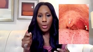146K views · 1.6K reactions | How to REMOVE TONSIL STONES AT HOME! (+ What Causes Them) | Dr. Jen Caudle | Facebook