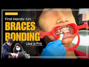 Braces Bonding Explained: Step-by-Step Guide for Perfect Orthodontic Treatment