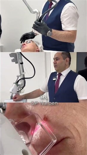 CO2 Laser Frankfurt | FIRE-XEL mit KI | Hautverjüngung & Narbenbehandlung