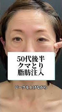 A monitor in her late 50s undergoing under-eye bag removal and fat injections 🌸