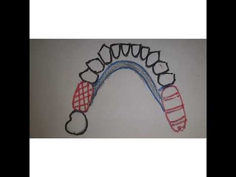 Path of Insertion and Guide Planes in Removable partial dentures