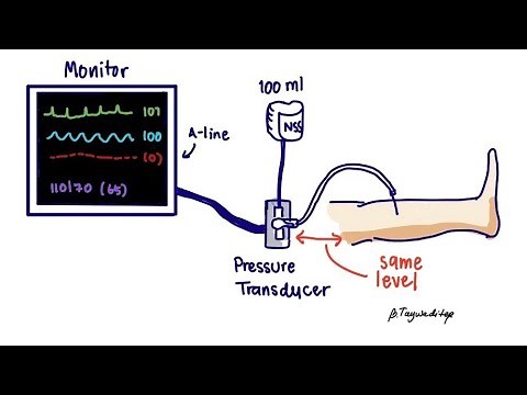 Compartment pressure measurement - A-line technique