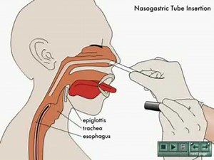 NurseReview Org Animation on Nasogastric Tube