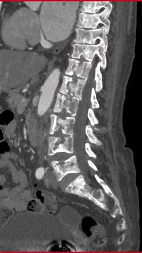 CT Lumber Spine #ctspine #spine #aiims #shorts #doctor #neet #anatomy #spineimaging #cricothyrotomy