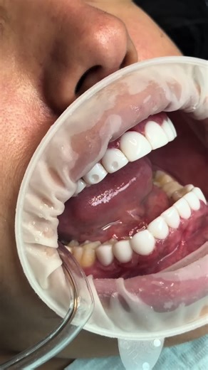 Transform Your Smile with Resin Veneers