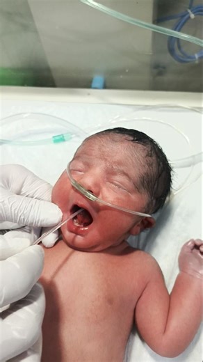 Newborn suctioning is done to clear airway secretions. (60–80 mmHg) for less than 5 #nicu