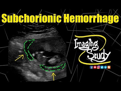Subchorionic Hemorrhage || Ultrasound || Case 193