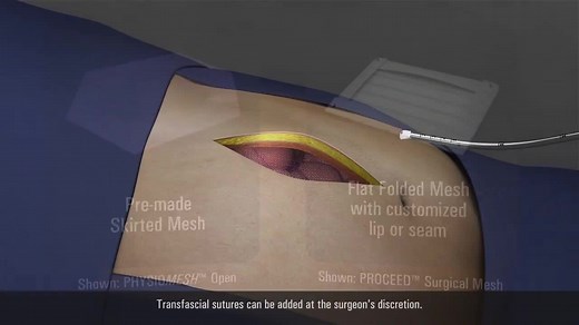 ETHICON SECURESTRAP Open Absorbable Strap Fixation Device | Ethicon