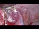 Laparoscopic Hysterectomy • Video • MEDtube.net