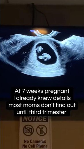 Twin pregnancy 7-week ultrasound #pregnant #twins #twinmom #twinpregnancy